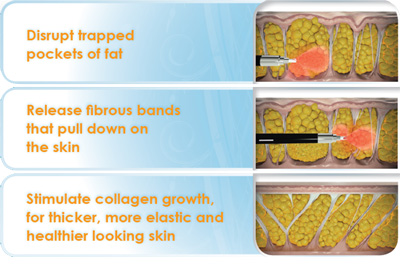 Laser Cellulite Removal Los Angeles CA