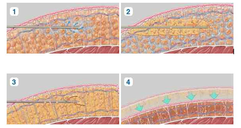 Liposuction Graphic
