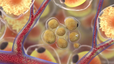 Fat cell after EMSculpt Treatment