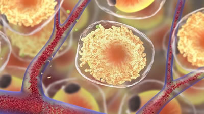 Fat cell before EmSculpt Treatment